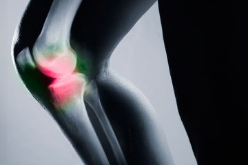 Deu no Exame: Sinovite Vilonodular