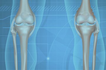 Deu no Exame: Edema Ósseo